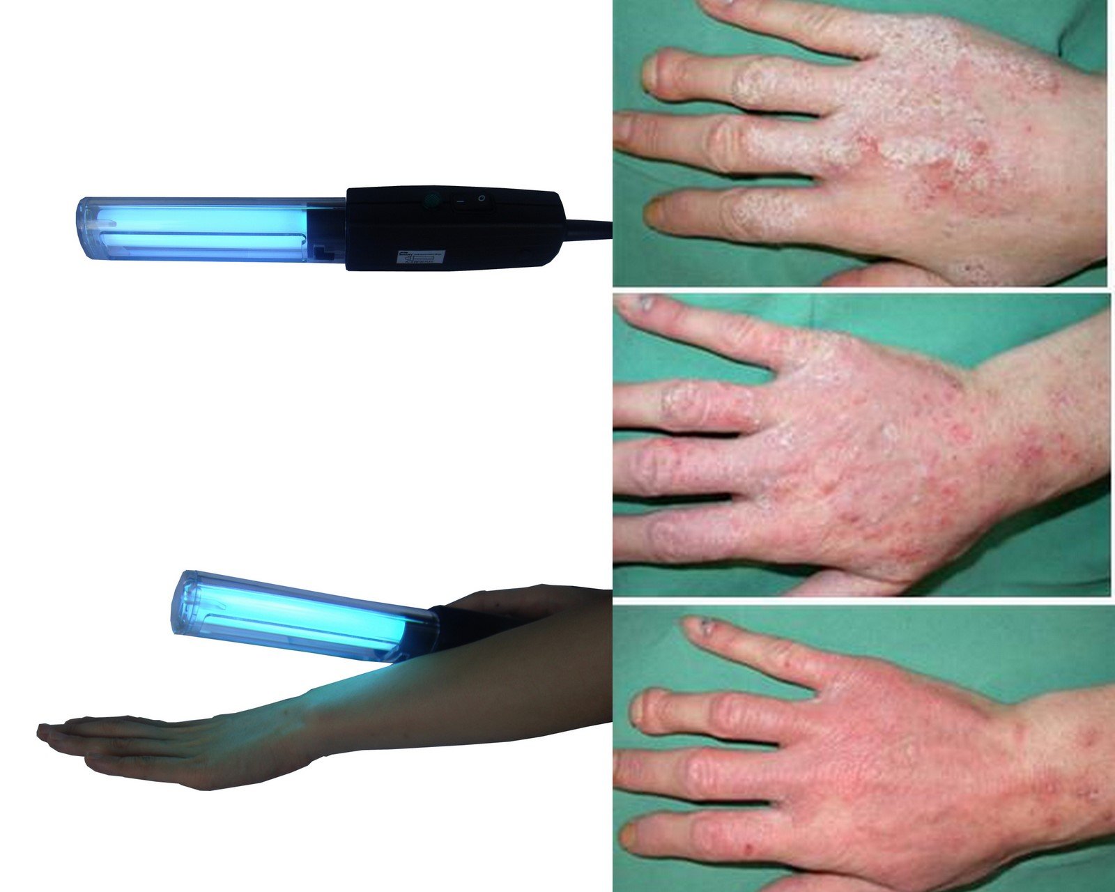 Eczemi a varicosity